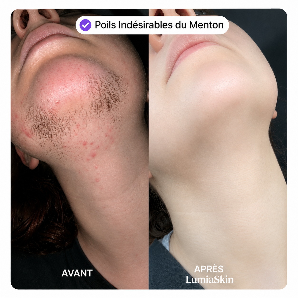 Kit Visage Lisse Sans Douleur